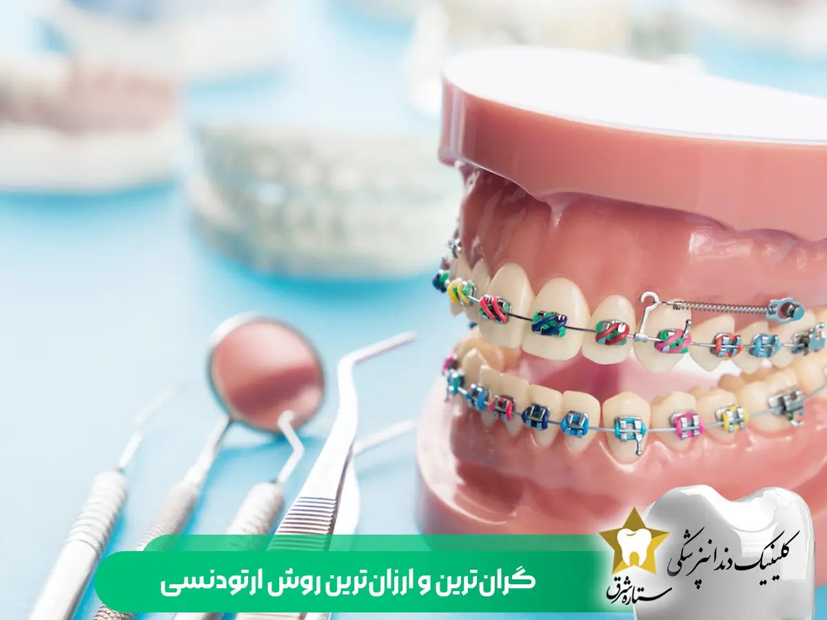 قیمت ارتودنسی ارزان دندان