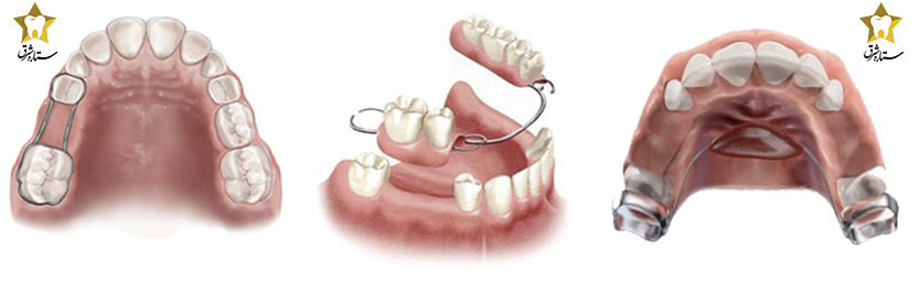 فضا نگهدارنده دندان چیست؟