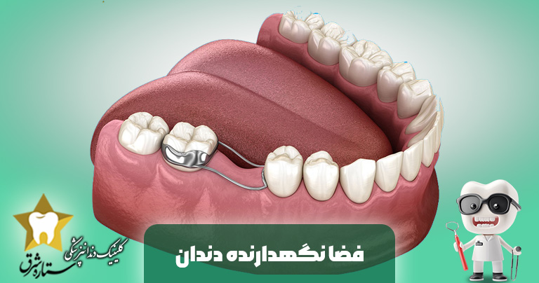 فضا نگهدارنده دندان کودک چیست؟