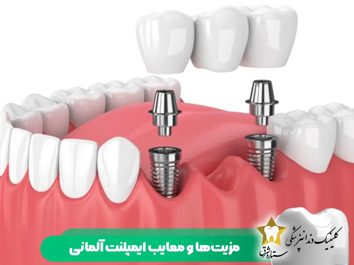 مزیت‌ها و معایب ایمپلنت آلمانی