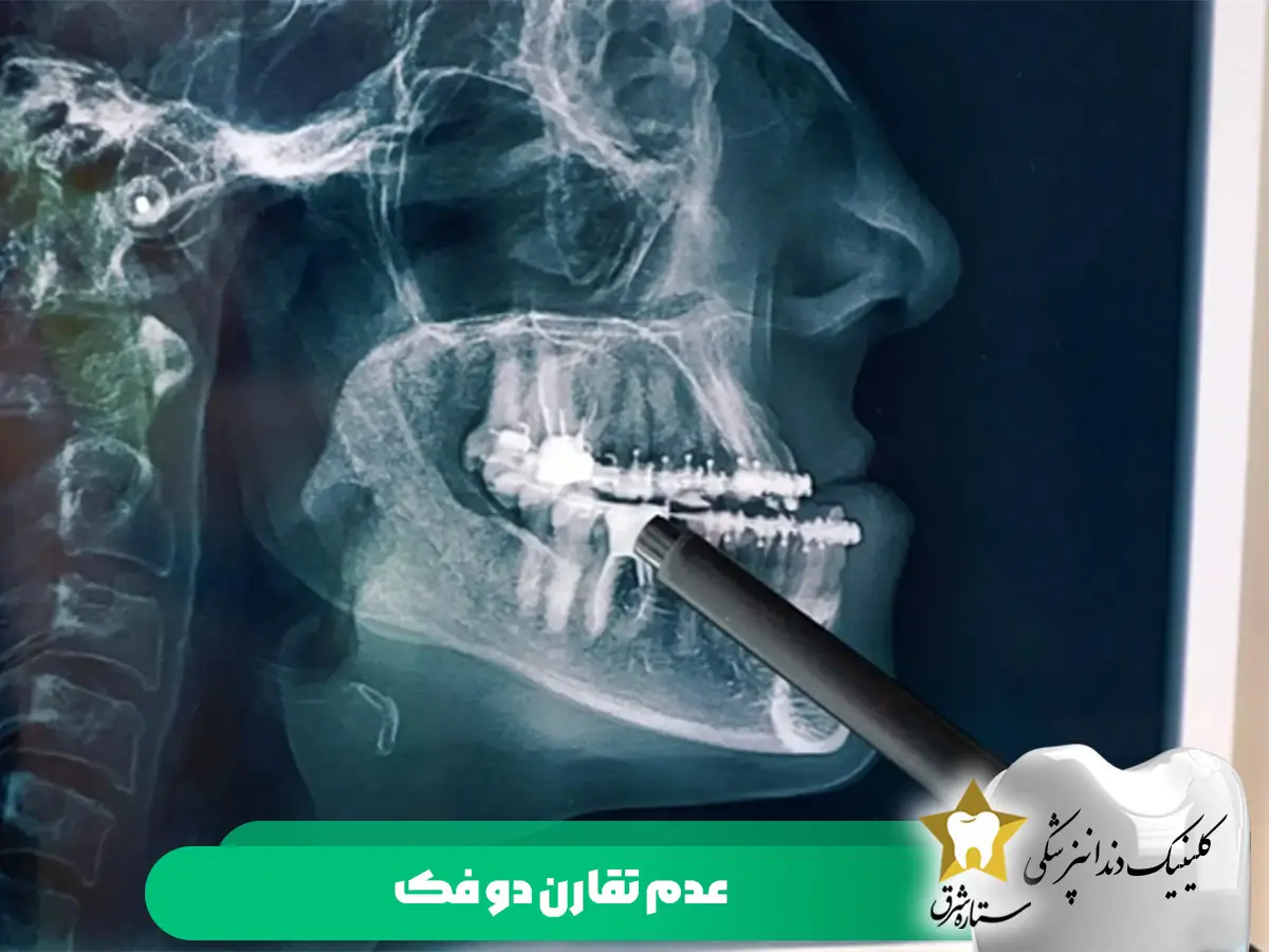 عدم تقارن دو فک