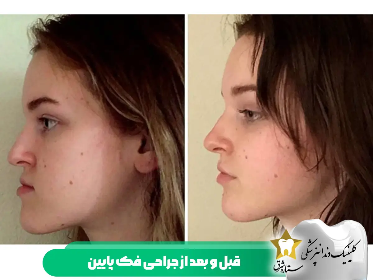 قبل و بعد جراحی فک پایین