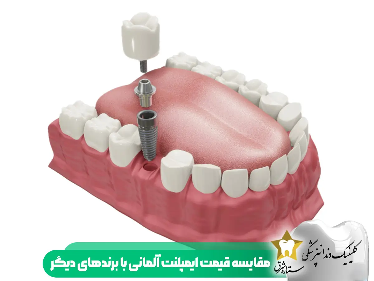 مقایسه قیمت ایمپلنت آلمانی با برندهای دیگر