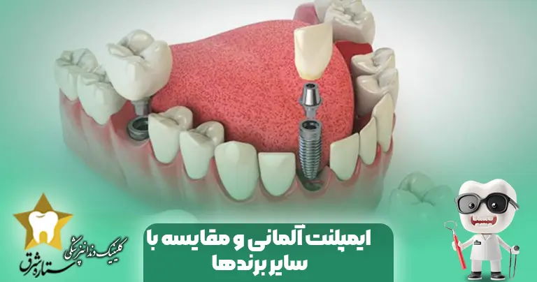 بررسی ایمپلنت آلمانی و مقایسه با سایر برندها