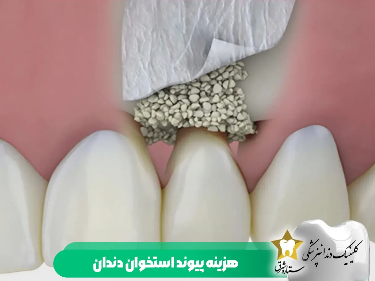 هزینه پیوند استخوان دندان 