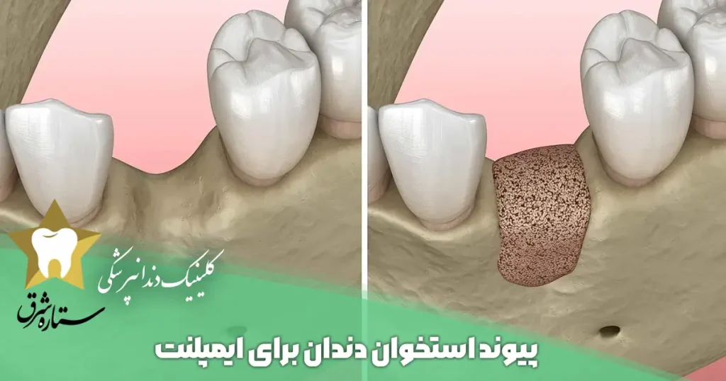 پیوند استخوان دندان برای ایمپلنت