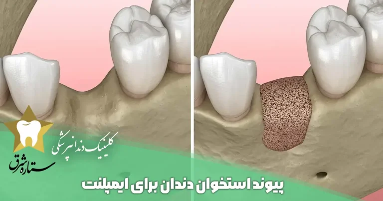 پیوند استخوان دندان برای ایمپلنت