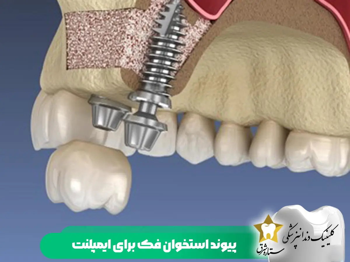 پیوند استخوان فک برای ایمپلنت
