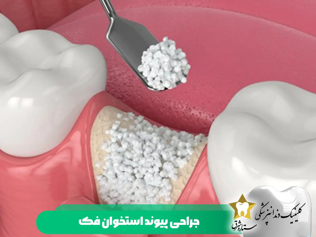 جراحی پیوند استخوان فک