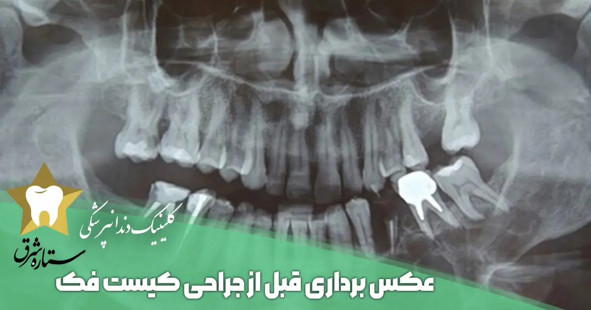 عکسبرداری قبل از عمل جراحی کیست فک