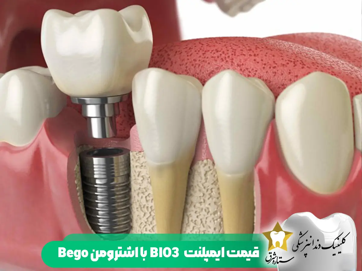 قیمت ایمپلنت bio3 با اشترومن bego