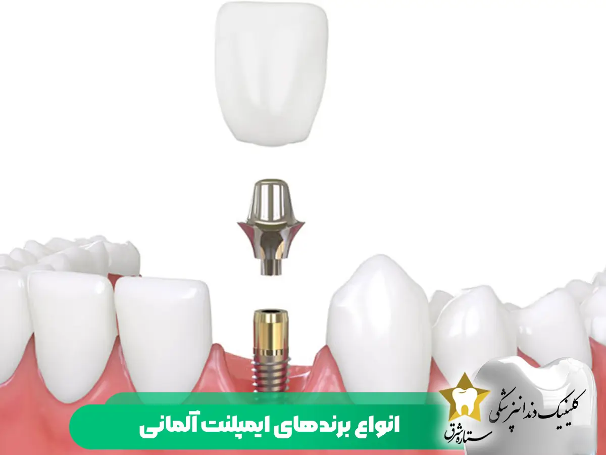 انواع برندهای ایمپلنت آلمانی