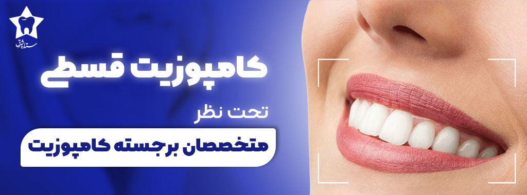 کامپوزیت قسطی