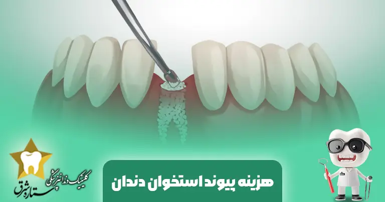 هزینه پیوند استخوان دندان