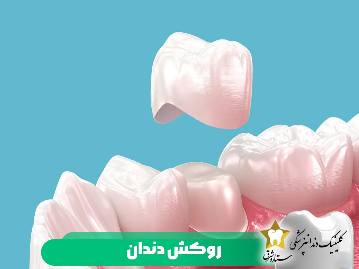 روکش دندان