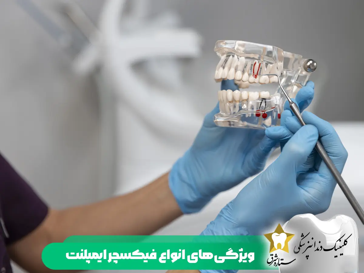 ویژگیهای انواع فیکسچر ایمپلنت