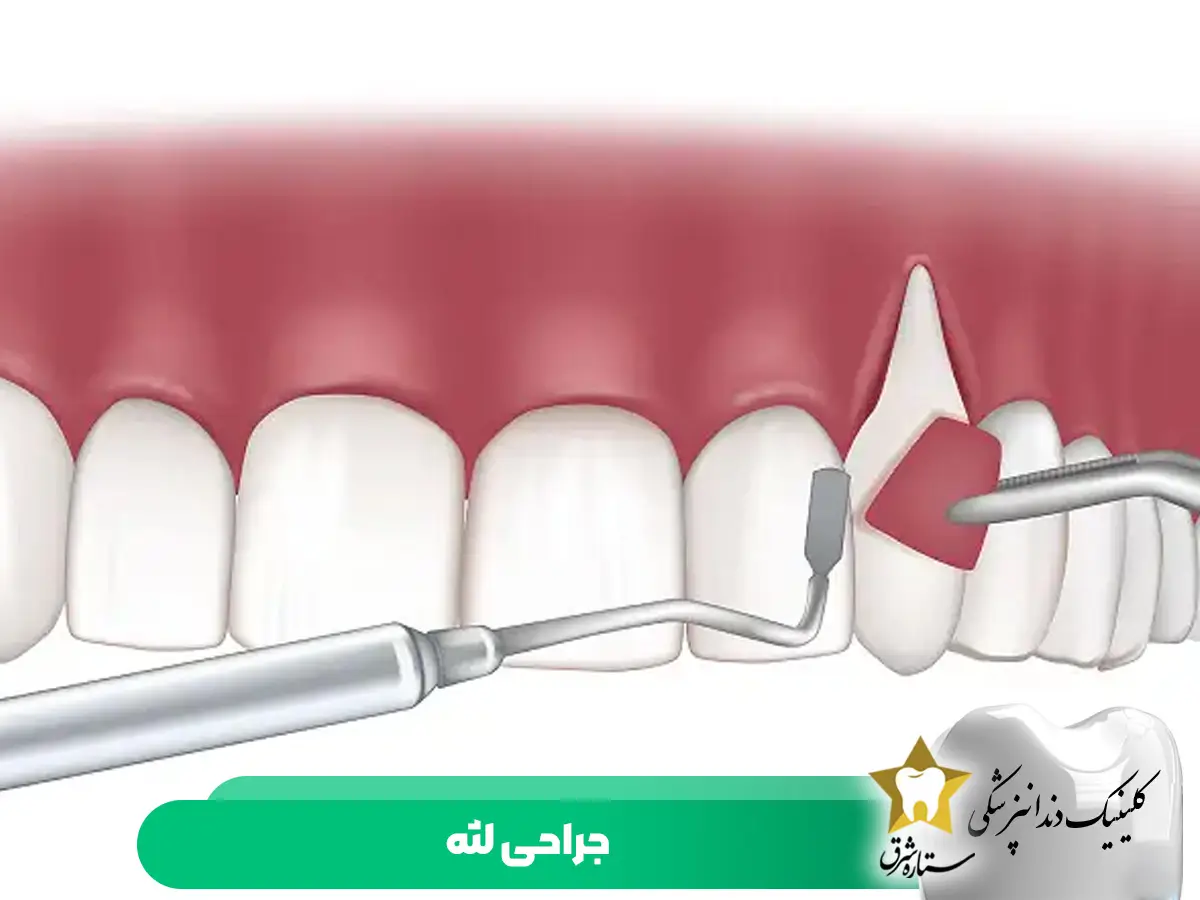 جراحی لثه
