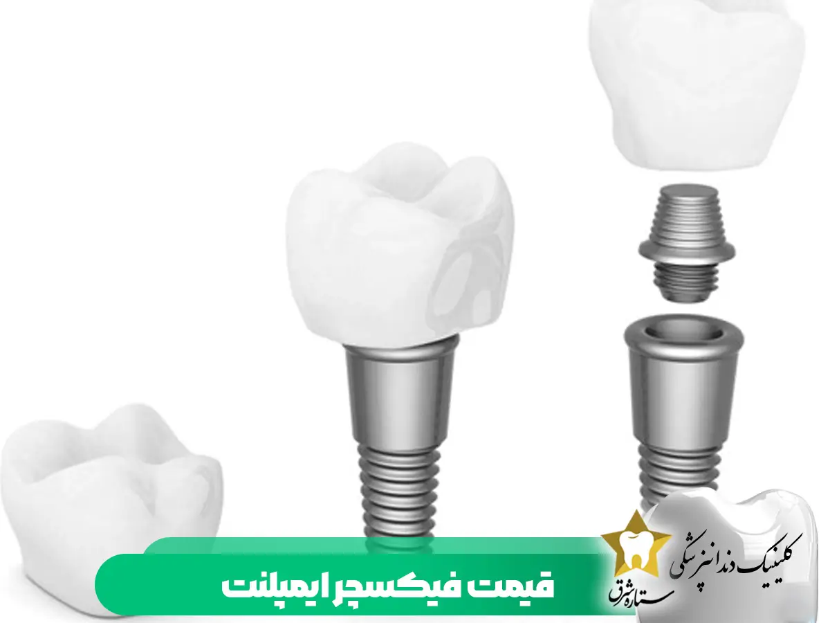 قیمت فیکسچر ایمپلنت