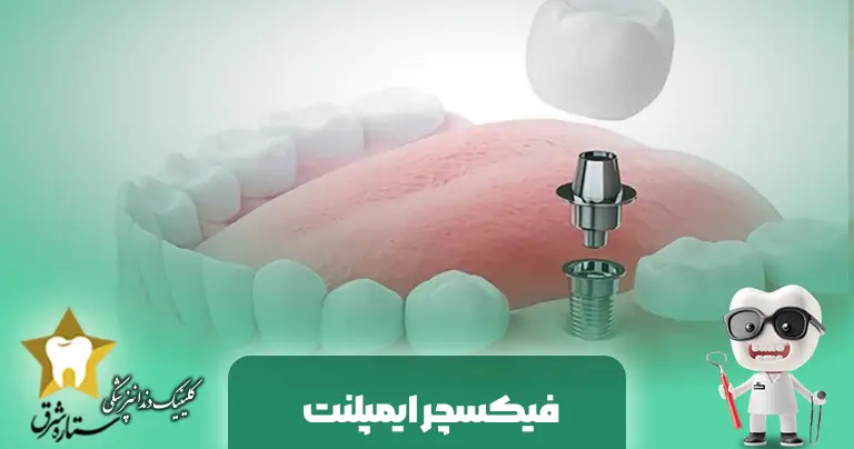 فیکسچر ایمپلنت