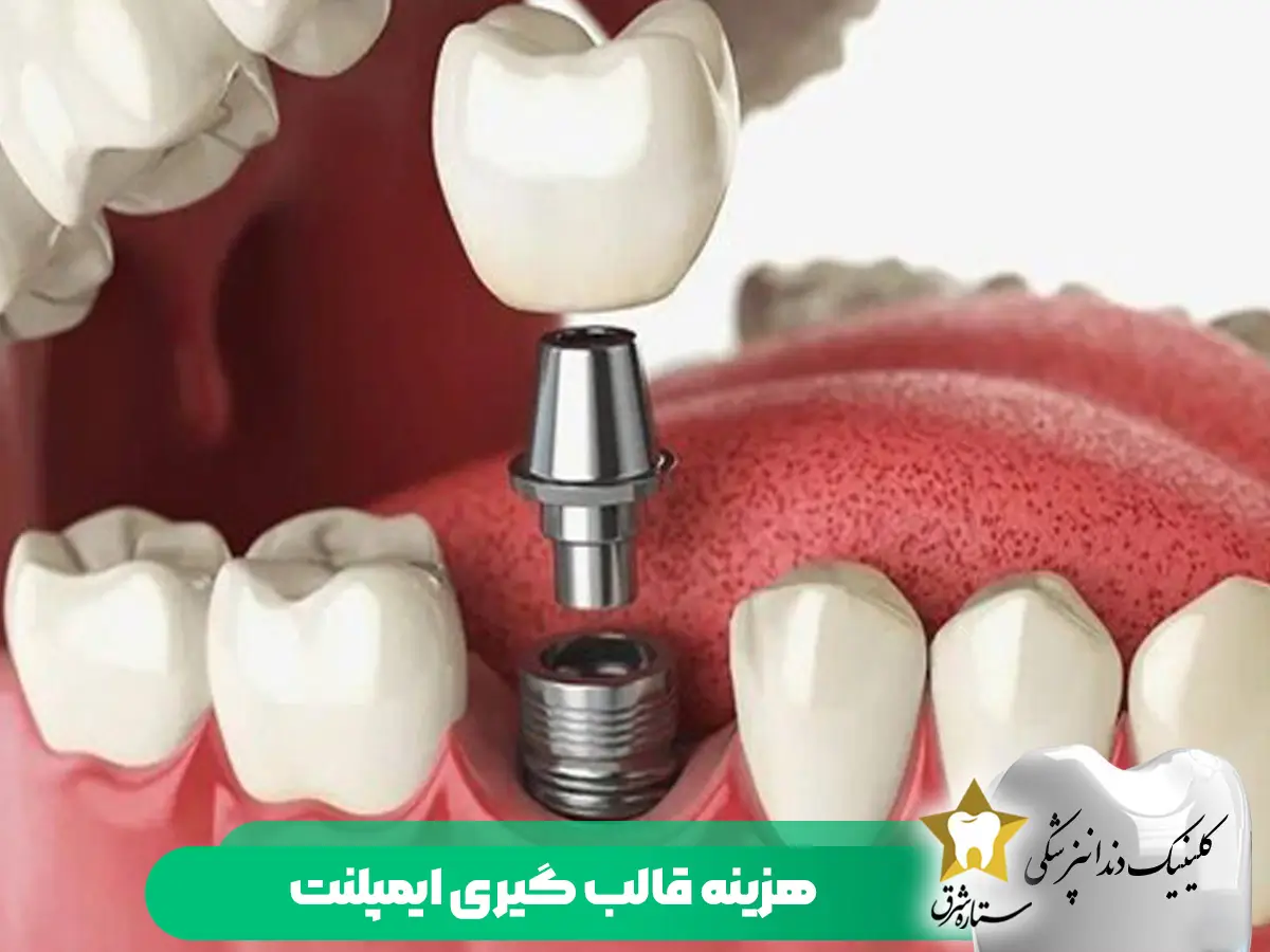 هزینه قالب گیری ایمپلنت
