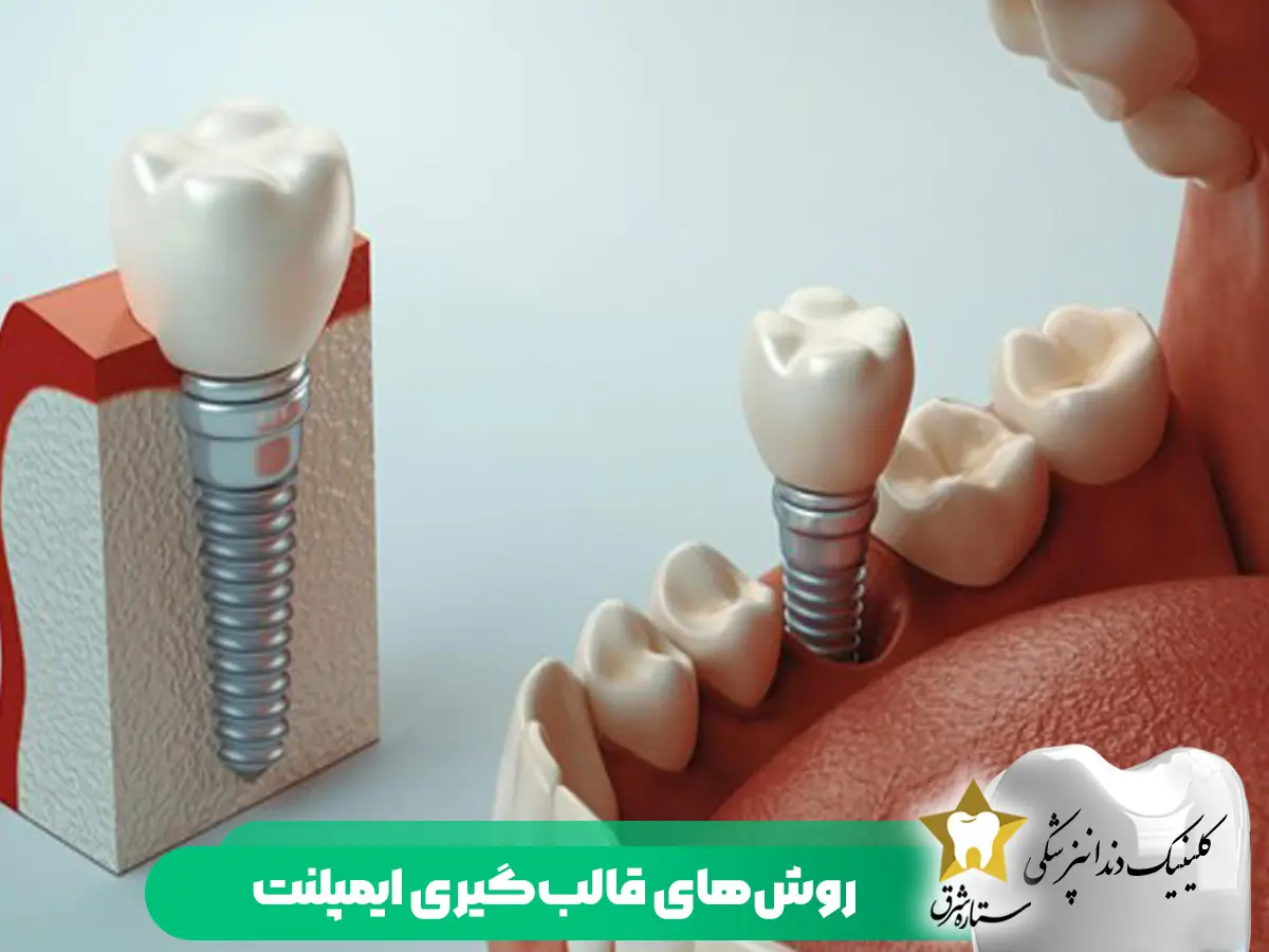 روش های قالب گیری ایمپلنت