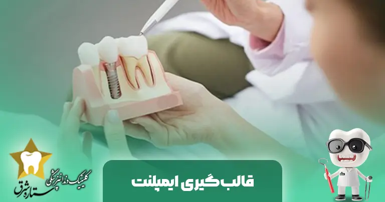 قالب گیری ایمپلنت