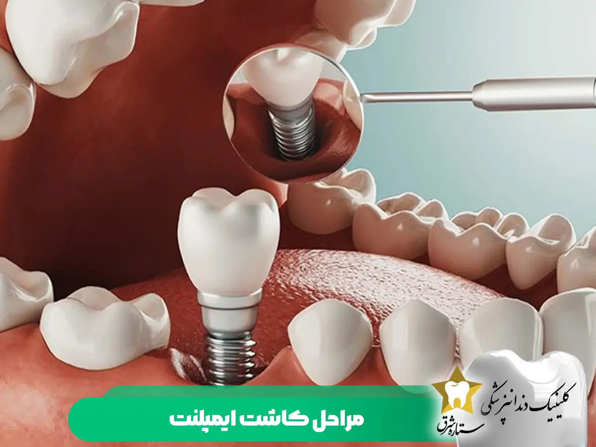 مراحل کاشت ایمپلنت