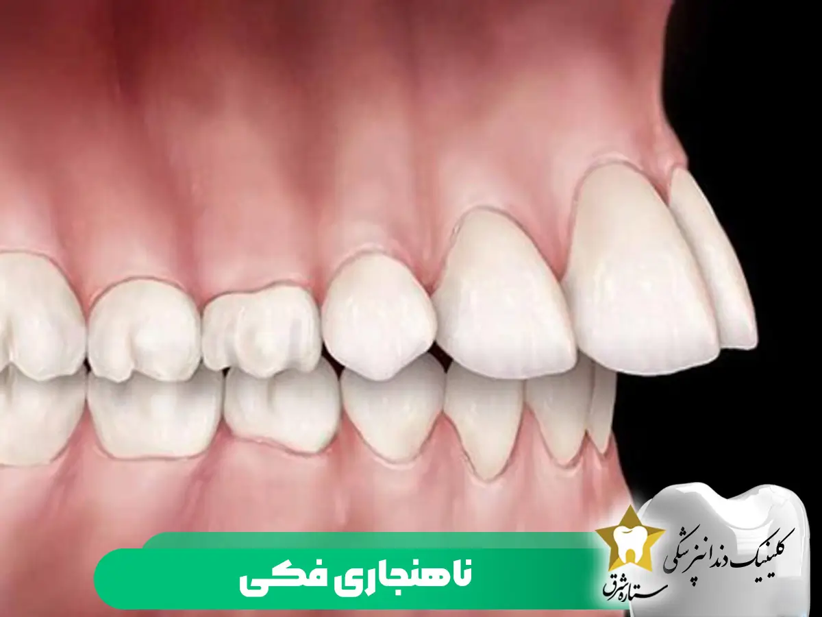 ناهنجاری فک بالا