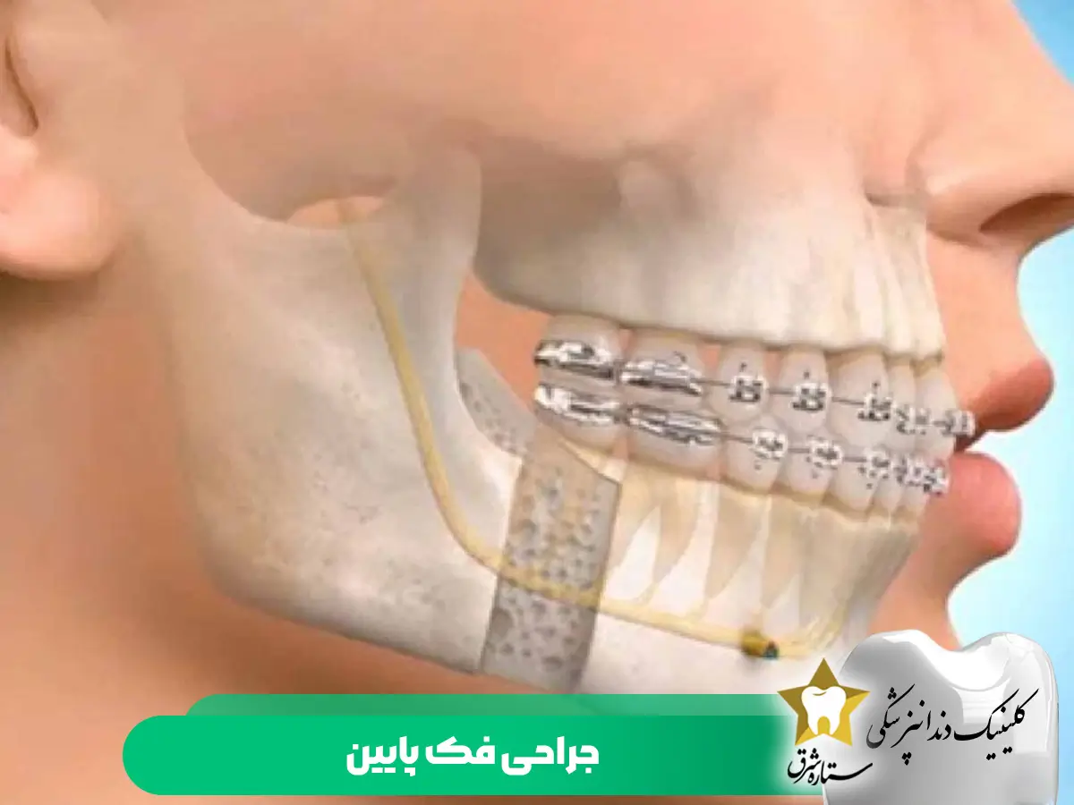 جراحی فک پایین