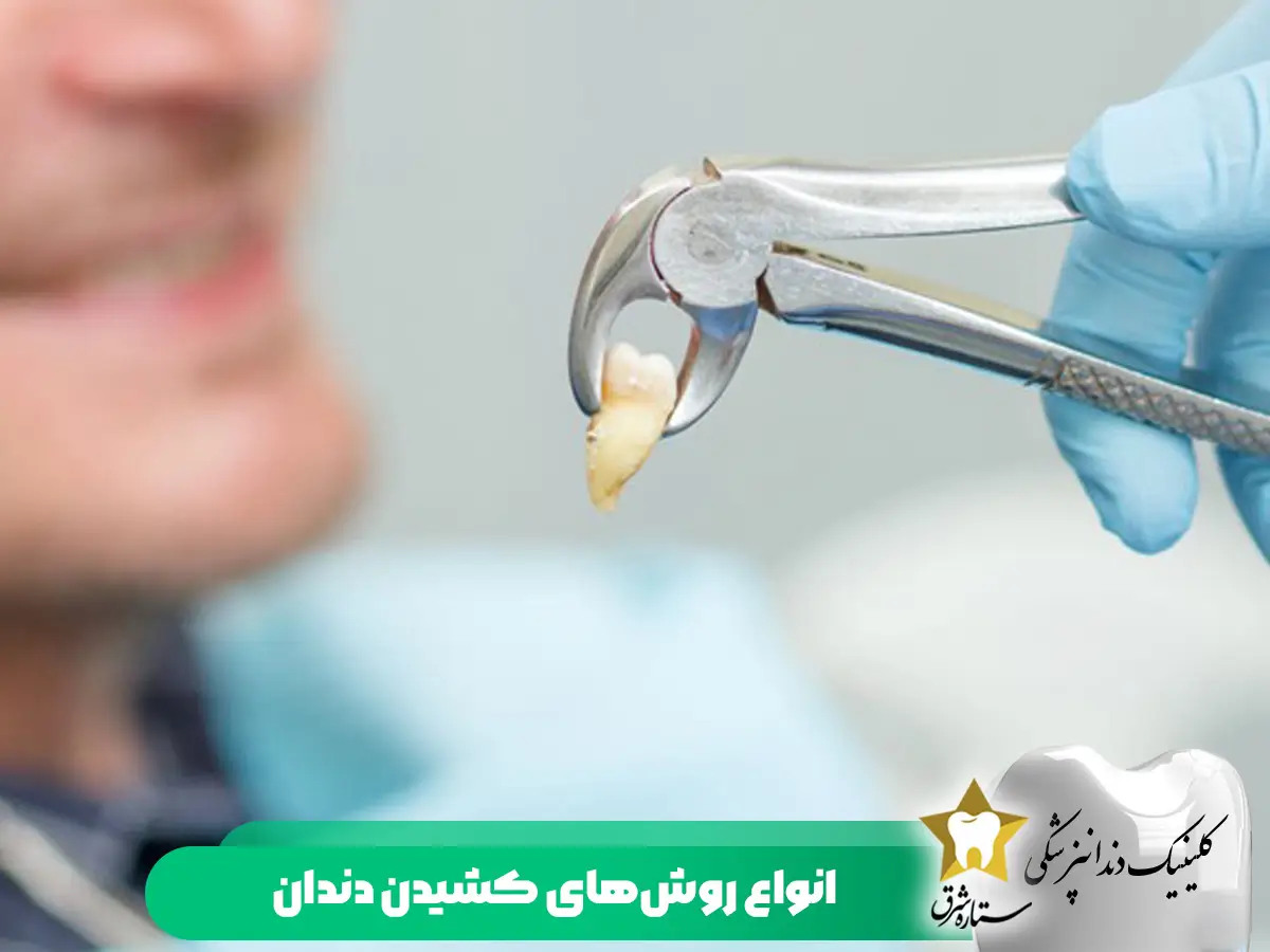 انواع روش‌های کشیدن دندان