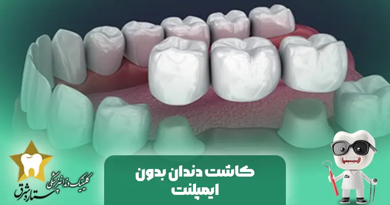 کاشت دندان بدون ایمپلنت