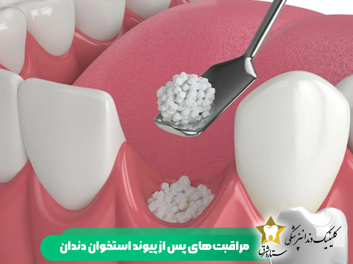 مراقبت های پس از پیوند استخوان دندان