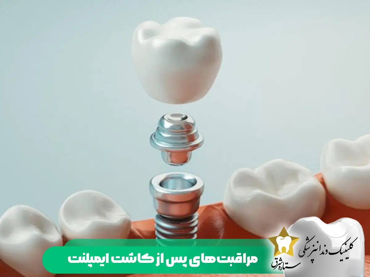 مراقبت های پس از کاشت ایمپلنت