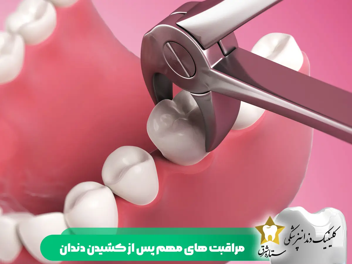 مراقبت های پس از کشیدن دندان