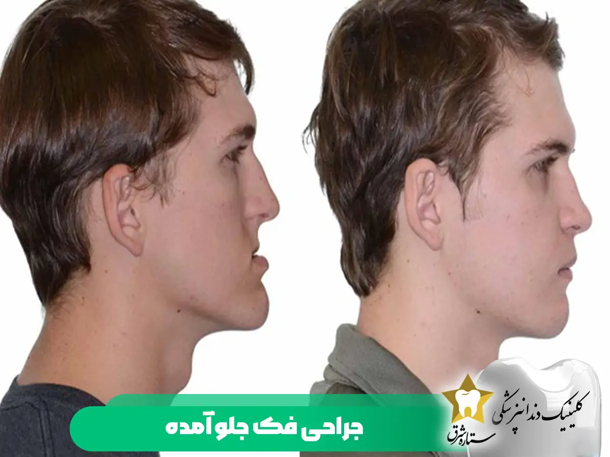 جراحی فک جلو آمده