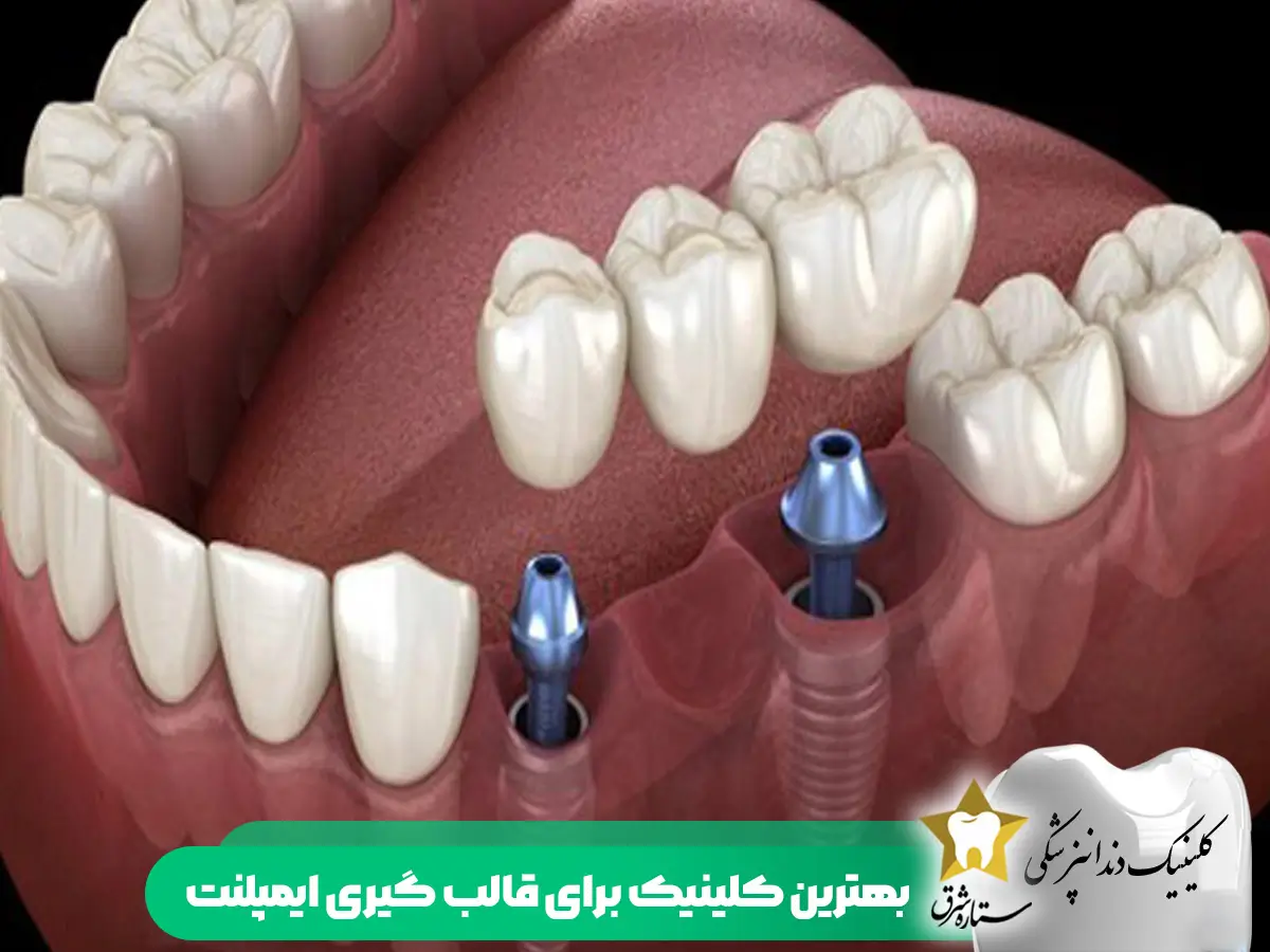 بهترین کلینیک قالب گیری ایمپلنت