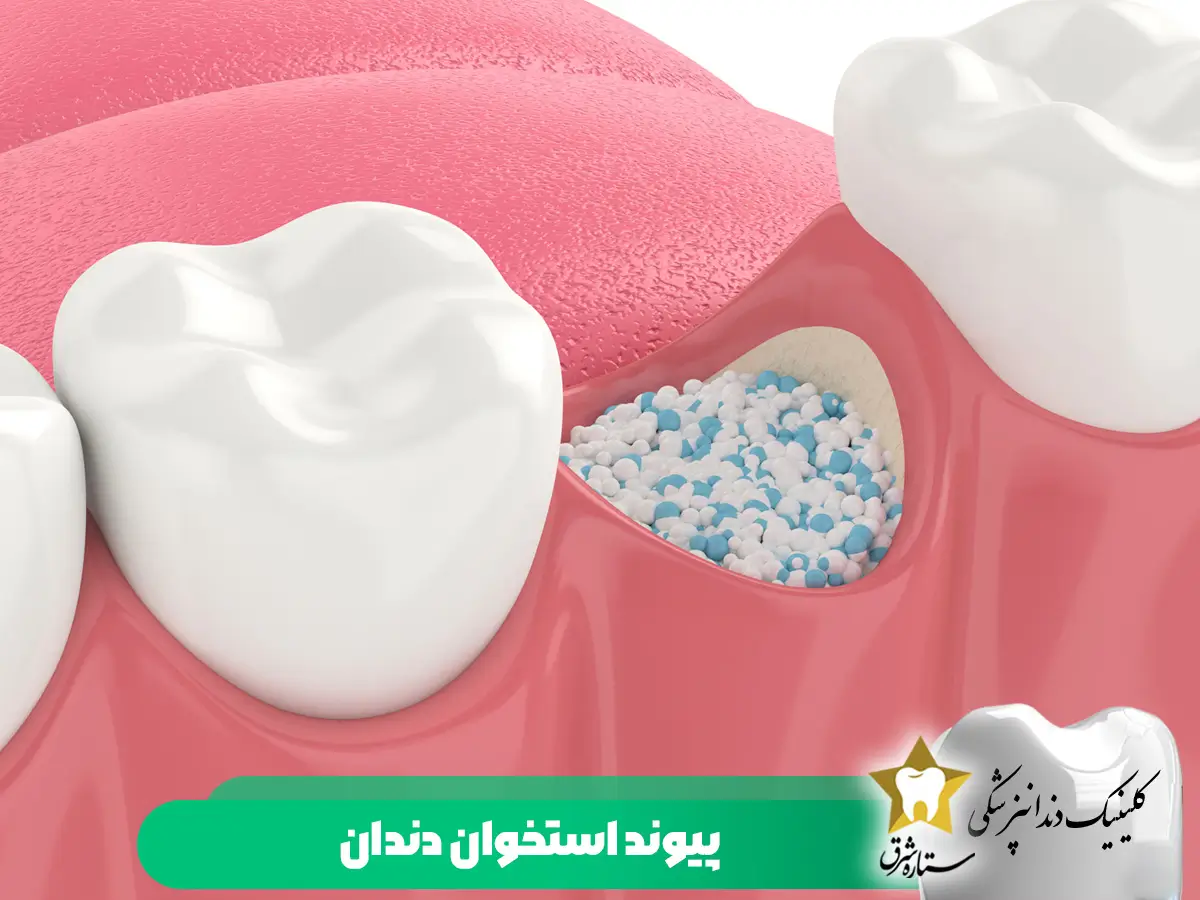 پیوند استخوان دندان