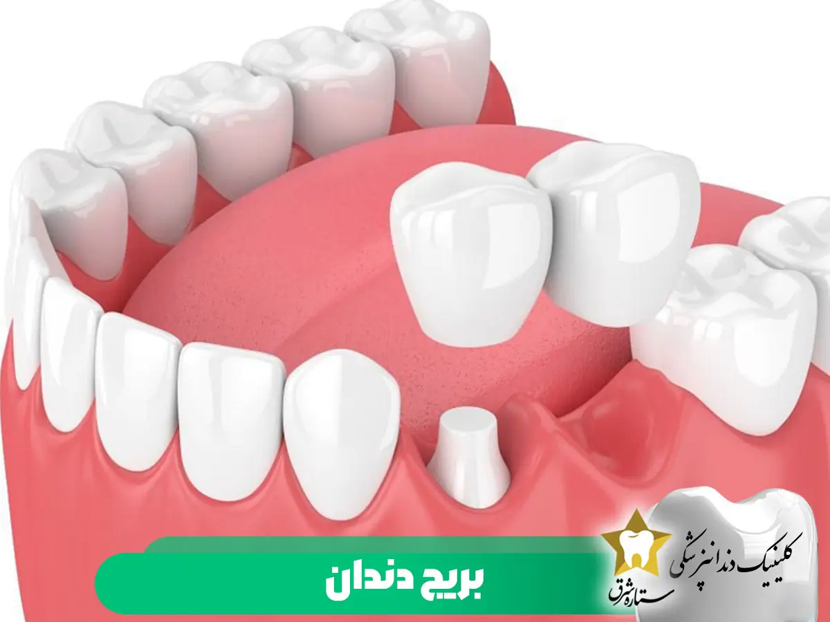 بریج دندان