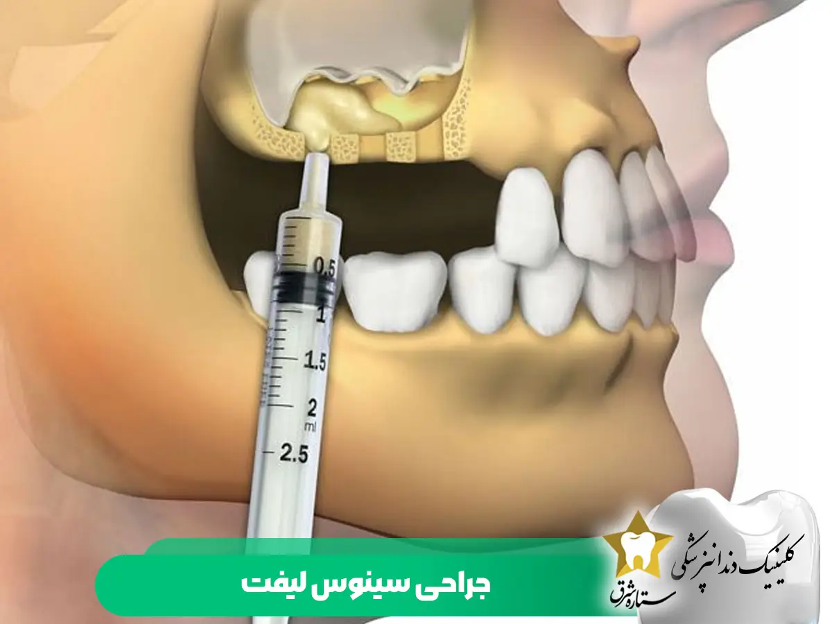 جراحی سینوس