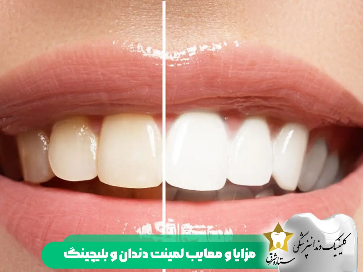 مزایا-معایب-لمینت دندان-و بلیچینگ
