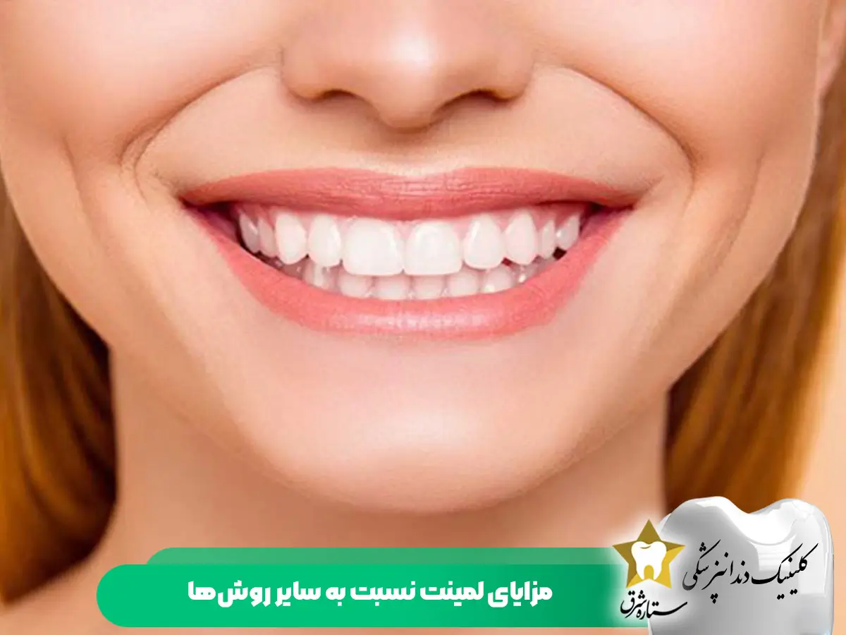 مزایای لمینت دندان جلو