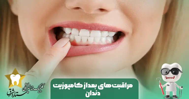 مراقبت‌های بعداز لمینت دندان