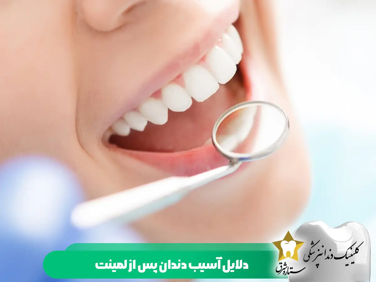 دلایل-آسیب دندان-پس از لمینت