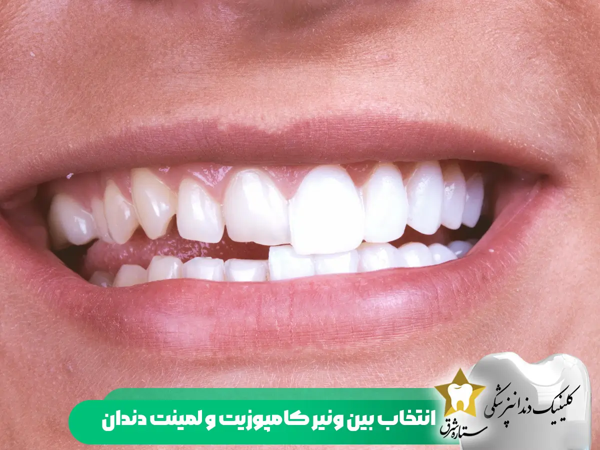 انتخاب کامپوزیت ونیر و معمولی