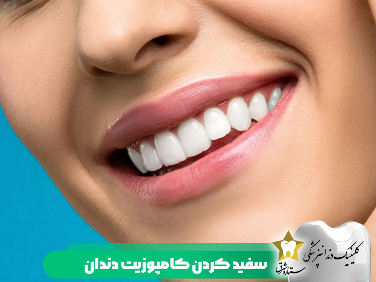 سفید کردن کامپوزیت دندان