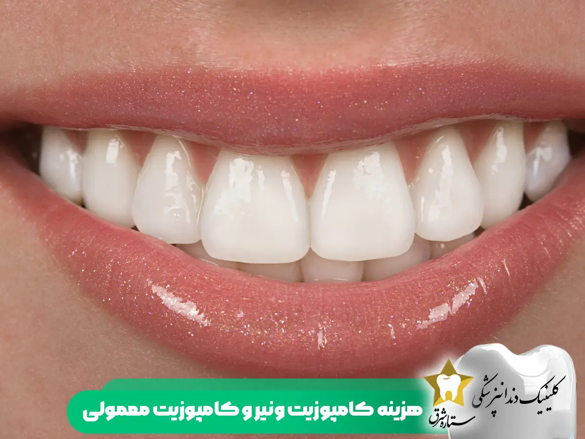 هزینه کامپوزیت ونیر و معمولی