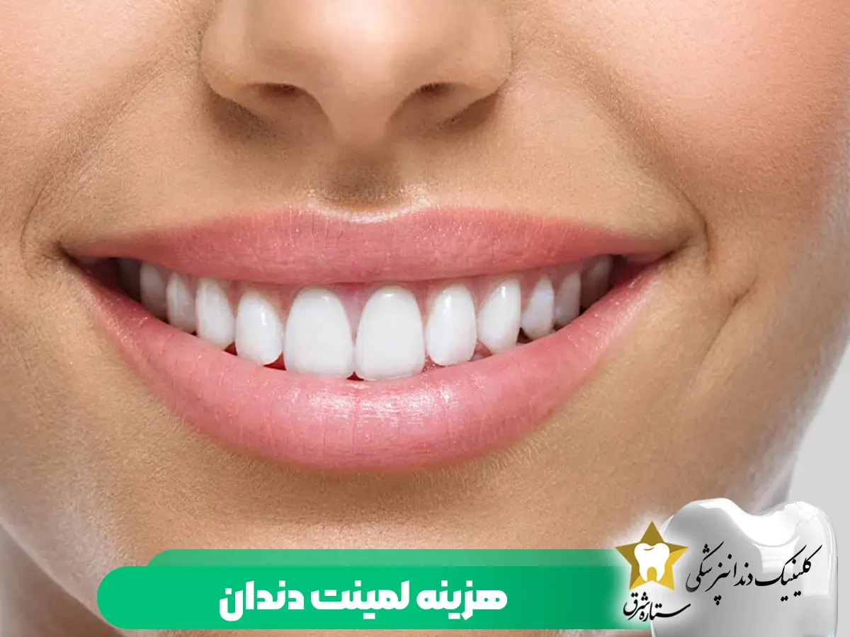 هزینه لمینت دندان