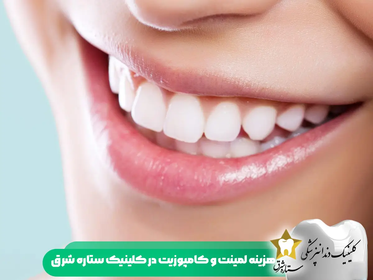 هزینه لمینت و کامپوزیت دندان در کلینیک ستاره شرق