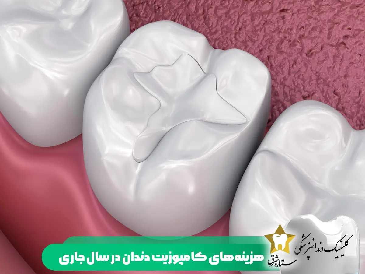 هزینه کامپوزیت دندان