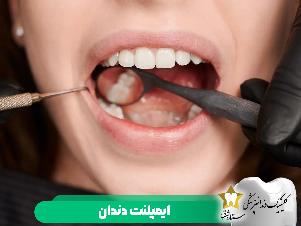 ایمپلنت دندان